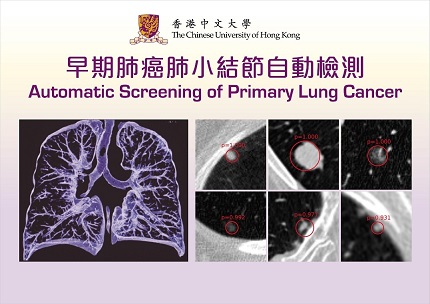   
		Fig. 1 Deep learning based system can accurately detect the primary lung cancer in CT images.	 
